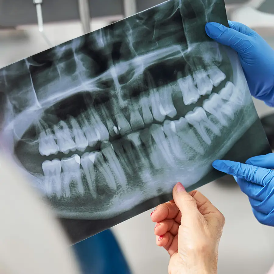 Röntgenaufnahme von Zähnen.