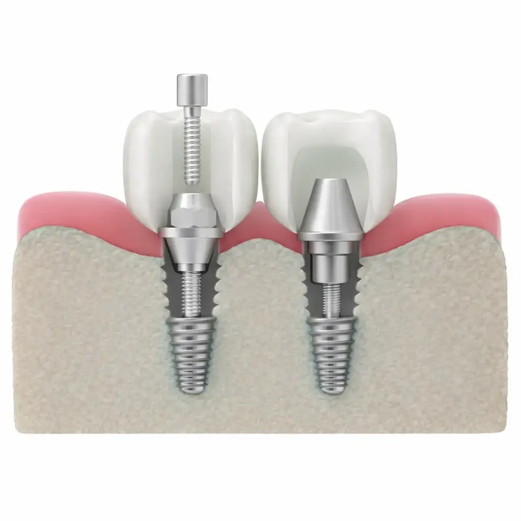 Dreidimensionale Illustration von Implantaten im Kieferknochen.